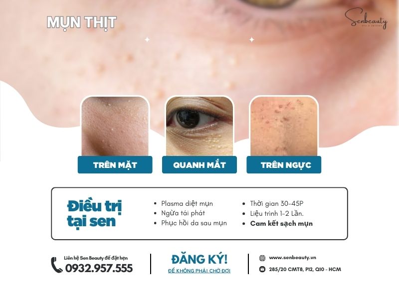 Trị các loại mụn nhọt trứng cá có cam kết